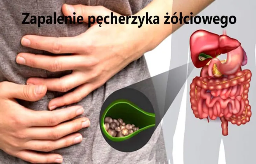 Zapalenie pęcherzyka żółciowego