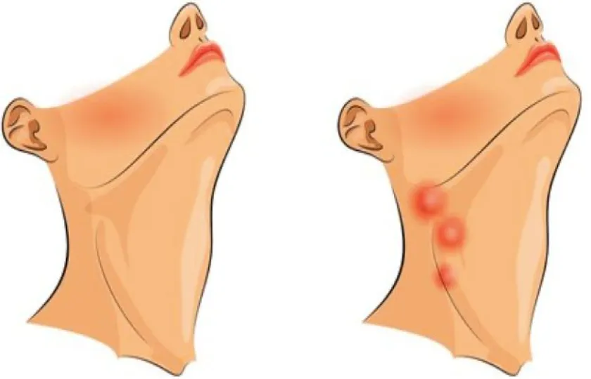 węzły podżuchwowe