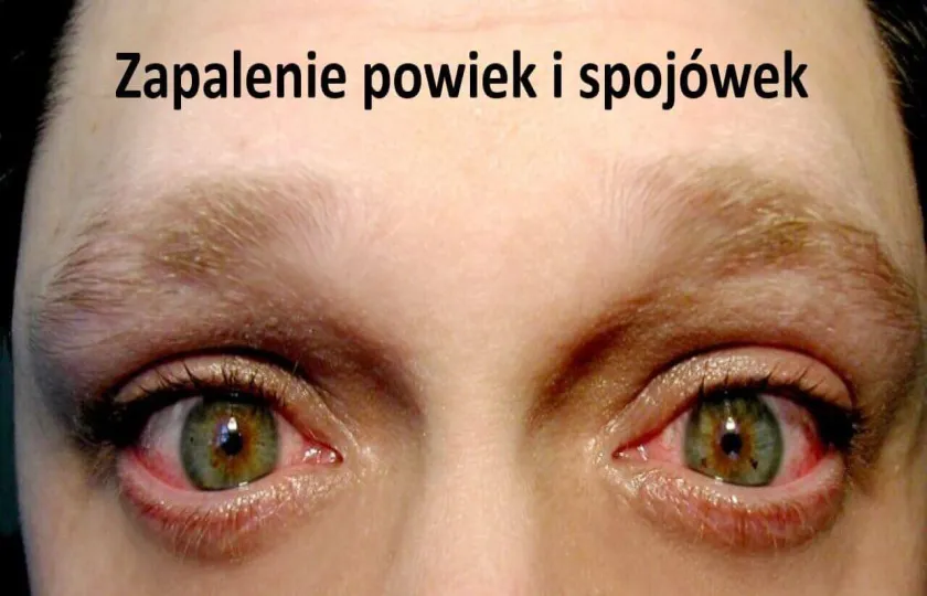 Zapalenie powiek i spojówek
