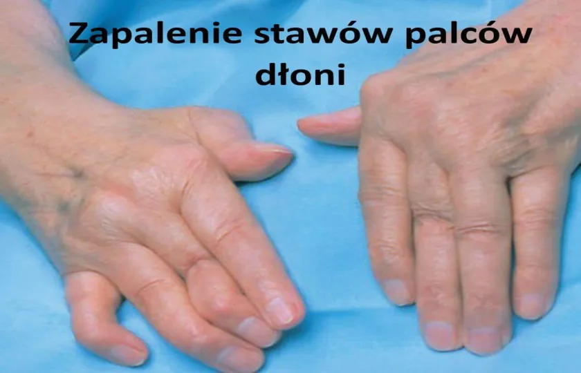 Zapalenie stawów palców dłoni 