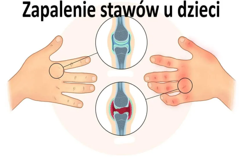 Zapalenie stawów u dzieci 