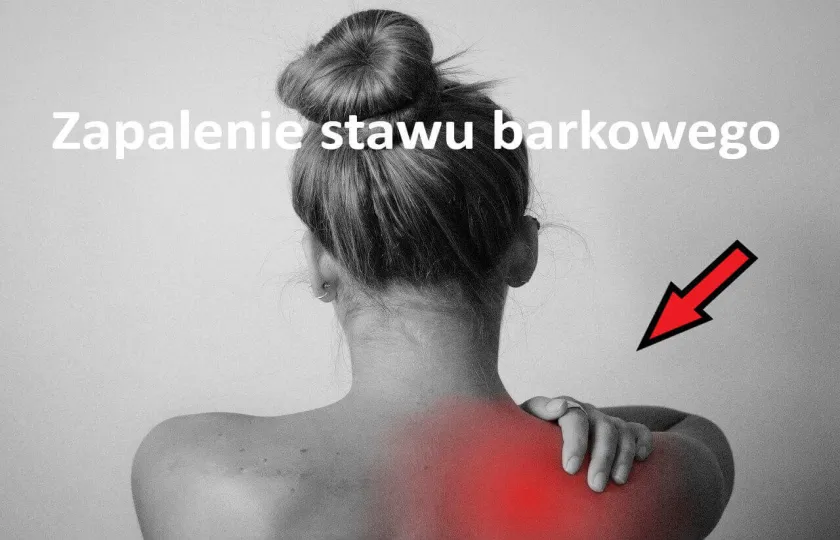 Zapalenie stawu barkowego 