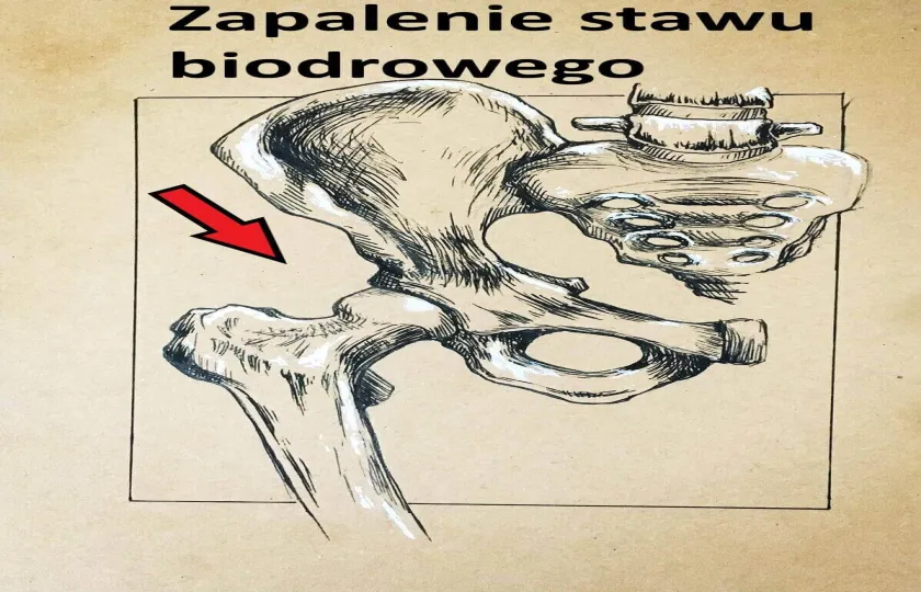 Zapalenie stawu biodrowego 