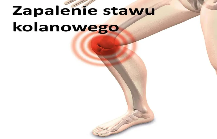 Zapalenie stawu kolanowego 
