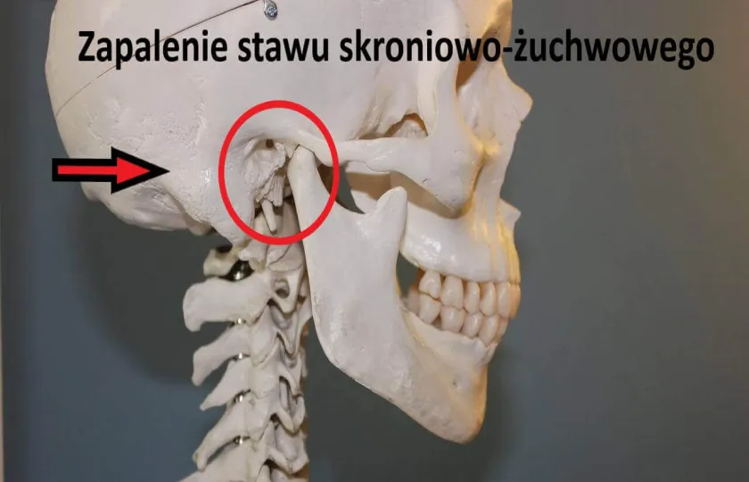 Zapalenie stawu skroniowo-żuchwowego 