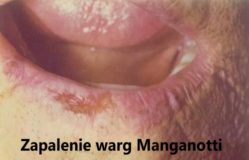 Zapalenie warg Manganotti 