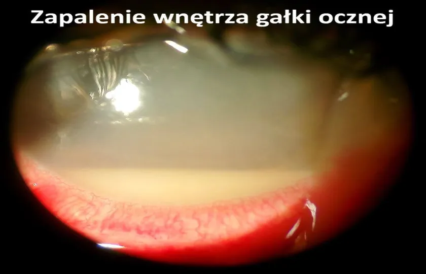Zapalenie wnętrza gałki ocznej 