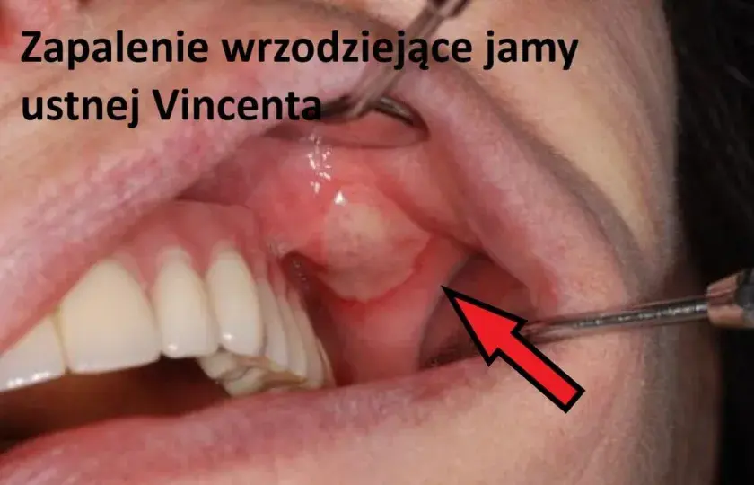 Zapalenie wrzodziejące jamy ustnej Vincenta 