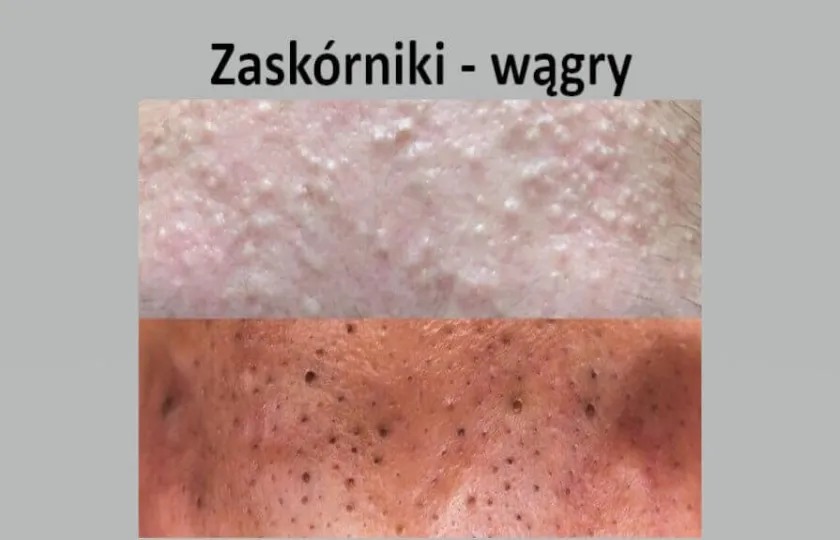 Zaskórniki, wągry