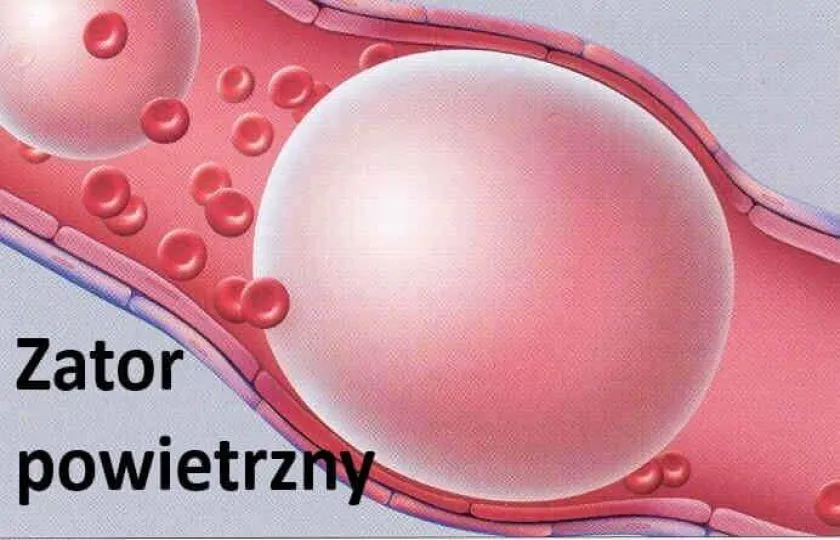 Zator powietrzny, zator gazowy, embolia