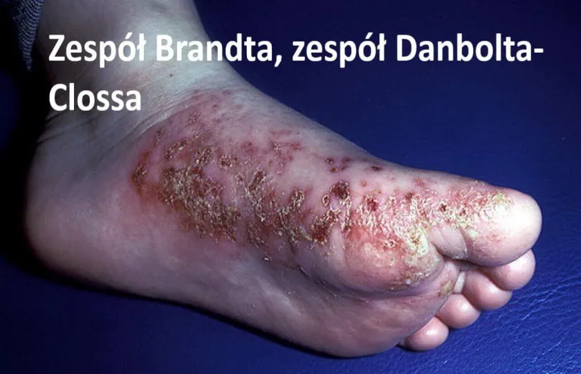 Zespół Brandta, zespół Danbolta-Clossa 