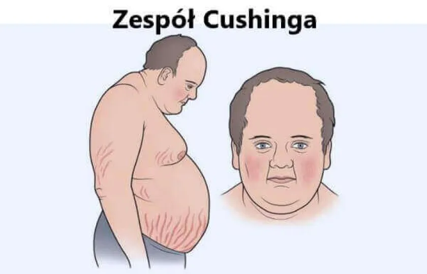 Zespół Cushinga 