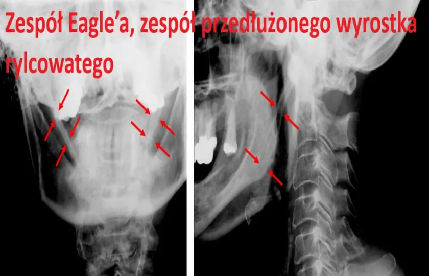 Zespół Eagle’a, stylalgia, zespół przedłużonego wyrostka rylcowatego