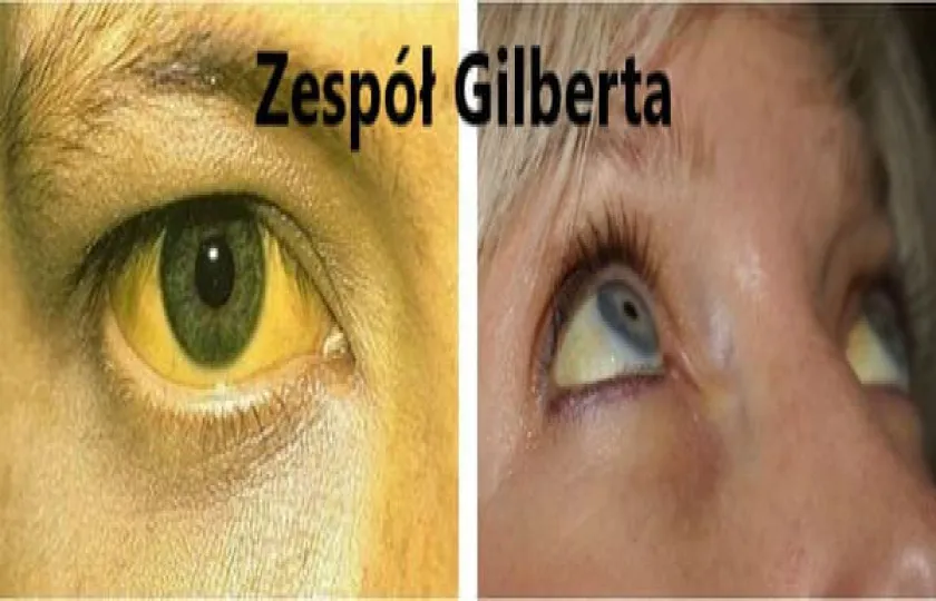 Zespół Gilberta