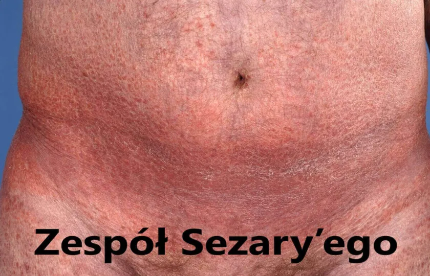Zespół Sezary’ego