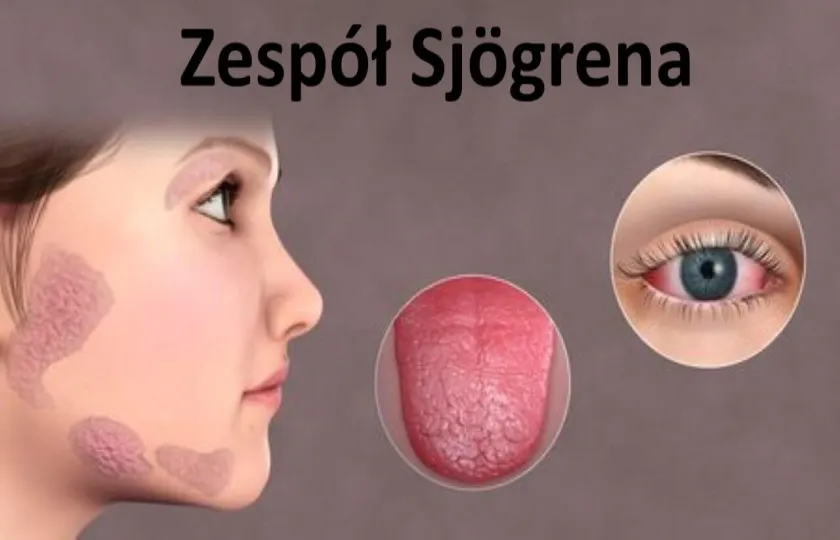 Zespół Sjögrena, choroba Sjögrena