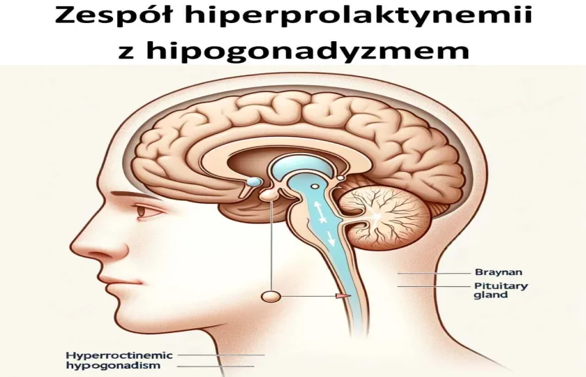 Zespół hiperprolaktynemii z hipogonadyzmem