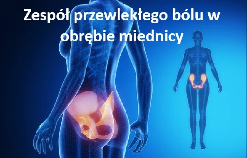 Zespół przewlekłego bólu w obrębie miednicy 
