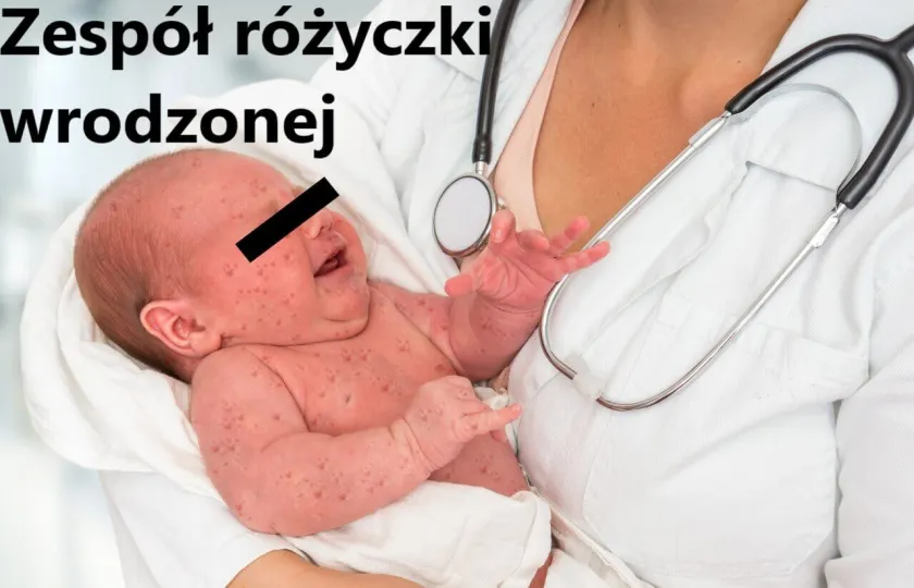 Zespół różyczki wrodzonej, Różyczka wrodzona