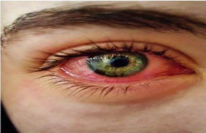 Zespół suchego oka