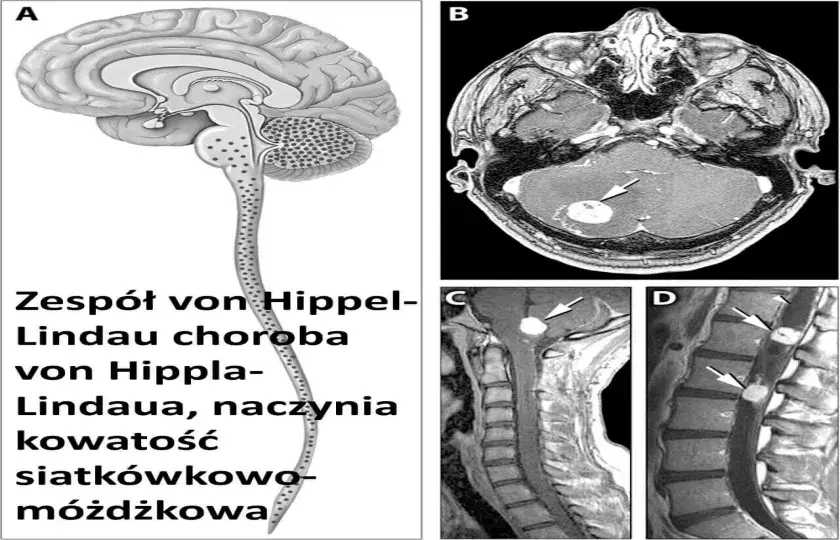 Zespół von Hippel-Lindau choroba von Hippla-Lindaua, naczyniakowatość siatkówkowo-móżdżkowa