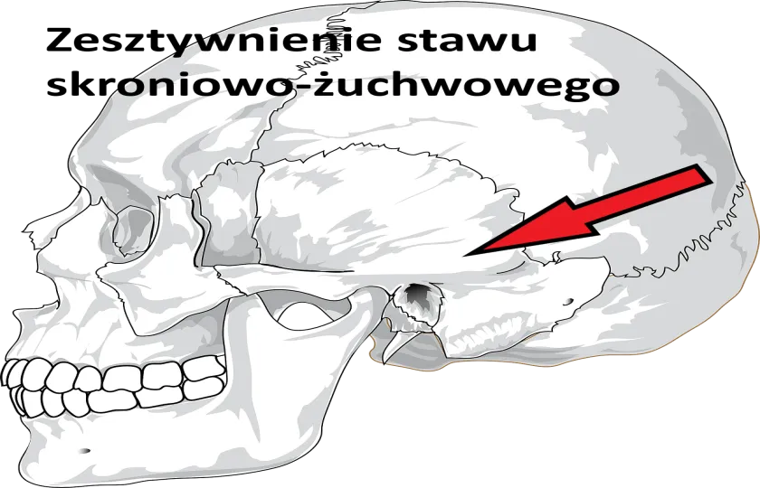 Zesztywnienie stawu skroniowo-żuchwowego 