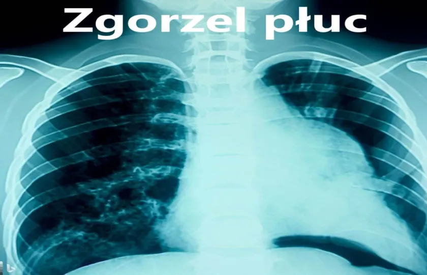 Zgorzel płuc