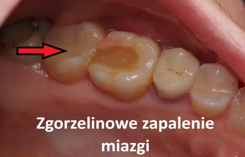 Zgorzelinowe zapalenie miazgi