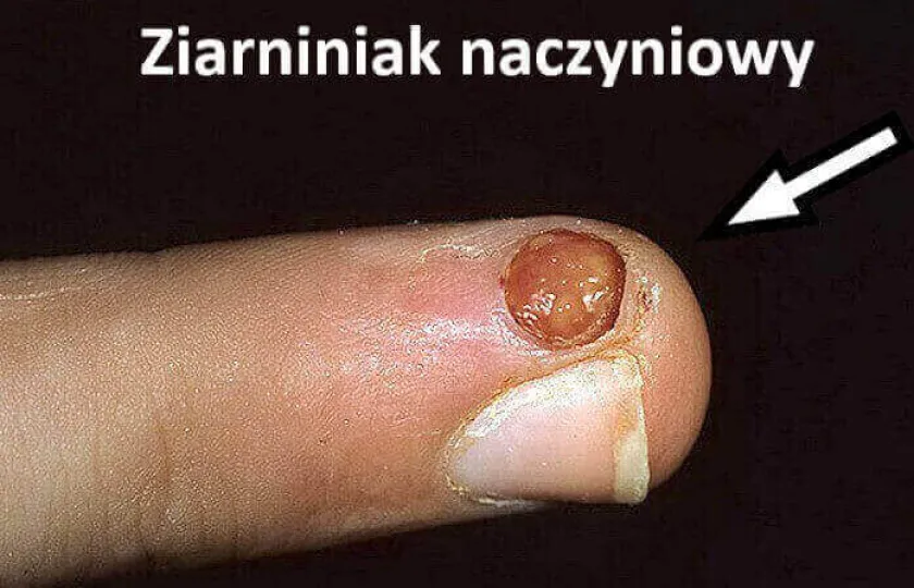 Ziarniniak naczyniowy 