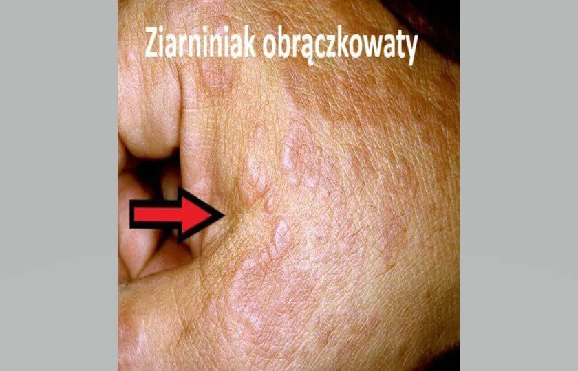 Ziarniniak obrączkowaty 