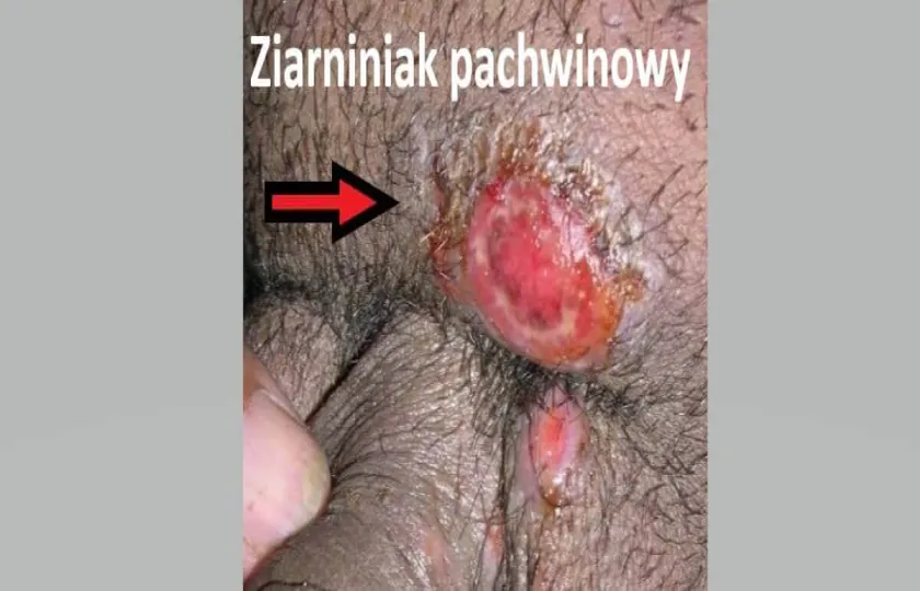 Ziarniniak pachwinowy