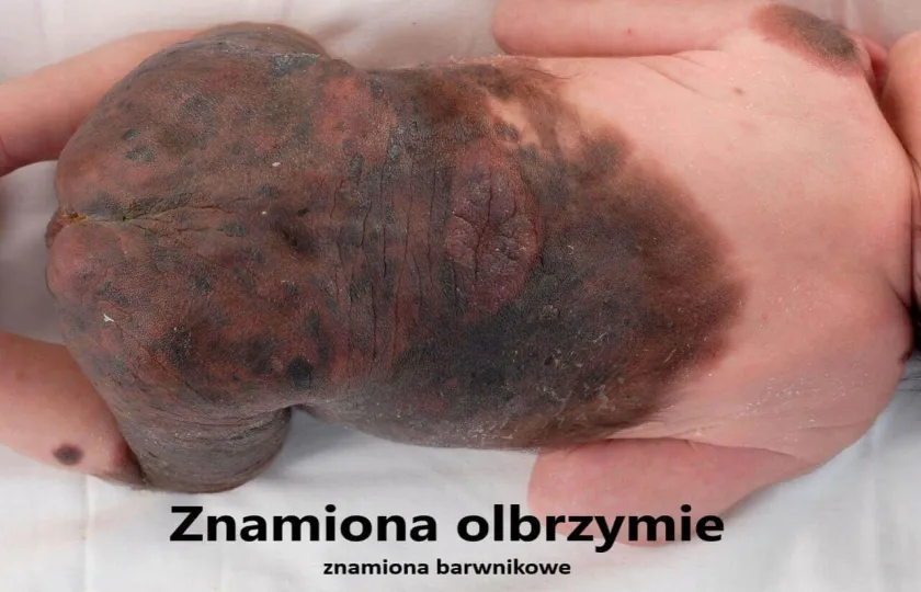 Znamię barwnikowe olbrzymie, znamiona olbrzymie, znamiona barwnikowe