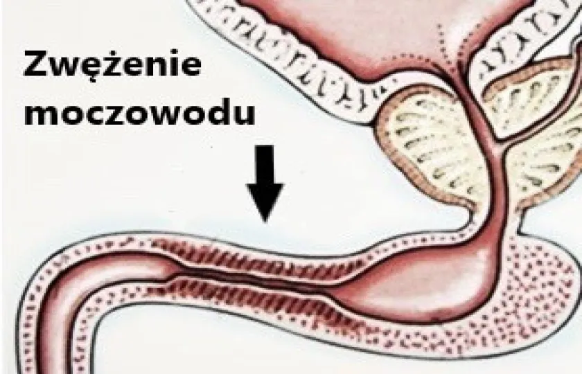 Zwężenie moczowodu 