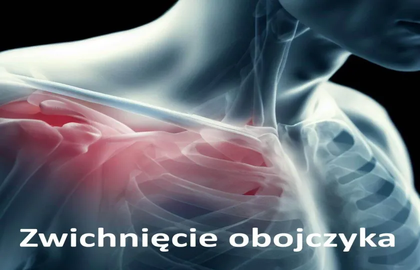 Zwichnięcie obojczyka