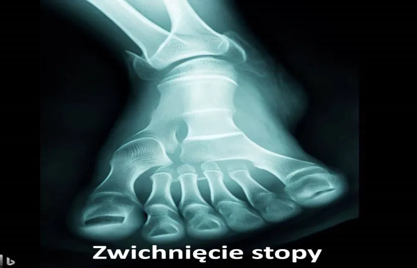 Zwichnięcie stopy