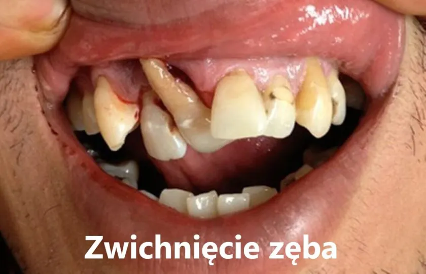 Zwichnięcie zęba
