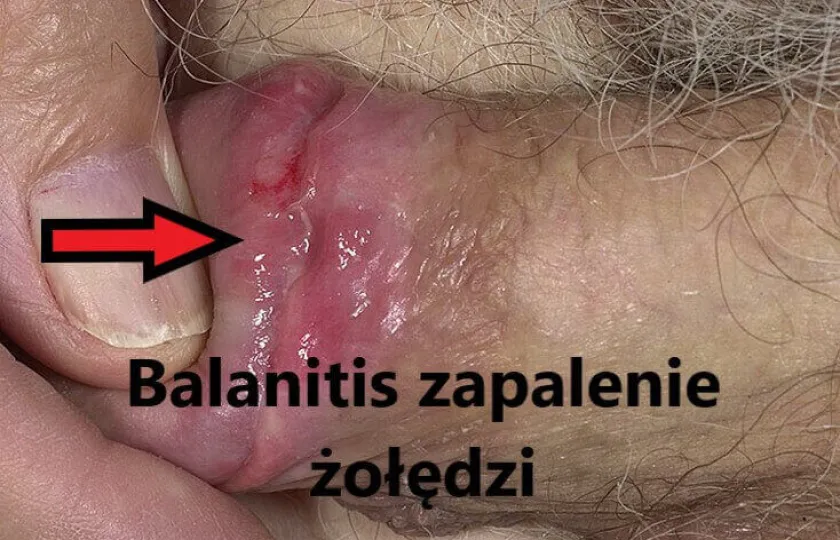 balanitis zapalenie żołędzi 