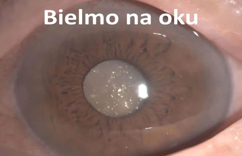 bielmo na oku, bielmo, leukoma 