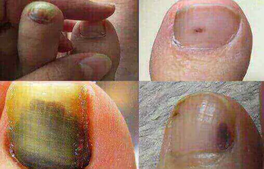 czerniak podaznokciowy 