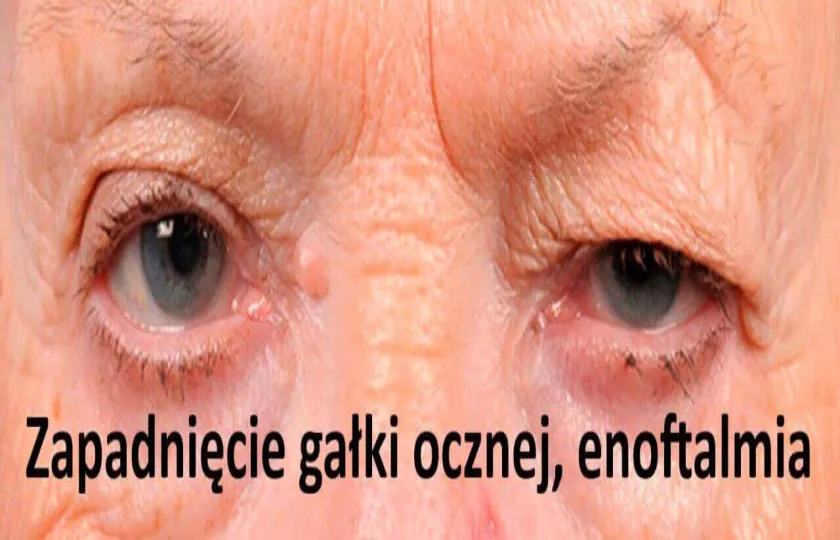 Zapadnięcie gałki ocznej, enoftalmia 