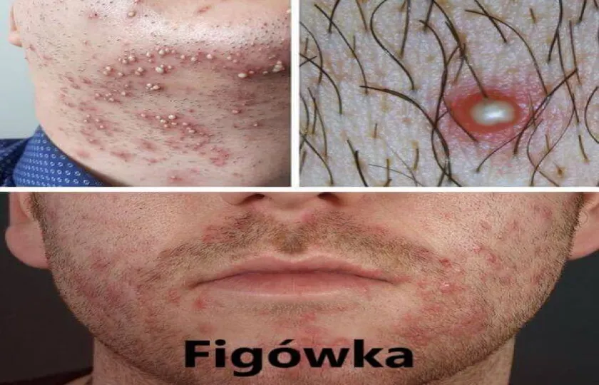 Figówka