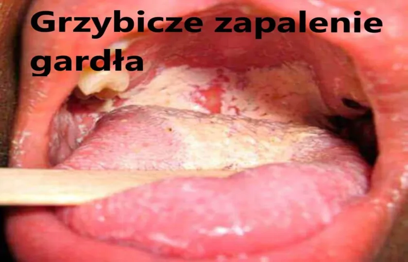grzybicze zapalenie gardła, grzybica gardła