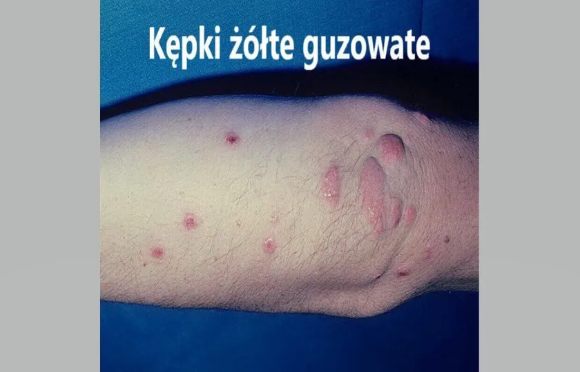 kępki żółte guzowate