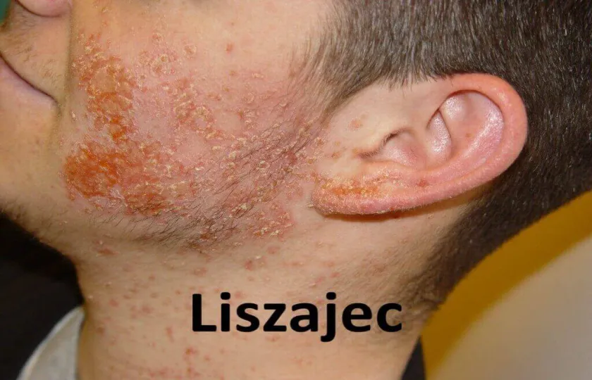 liszajec 