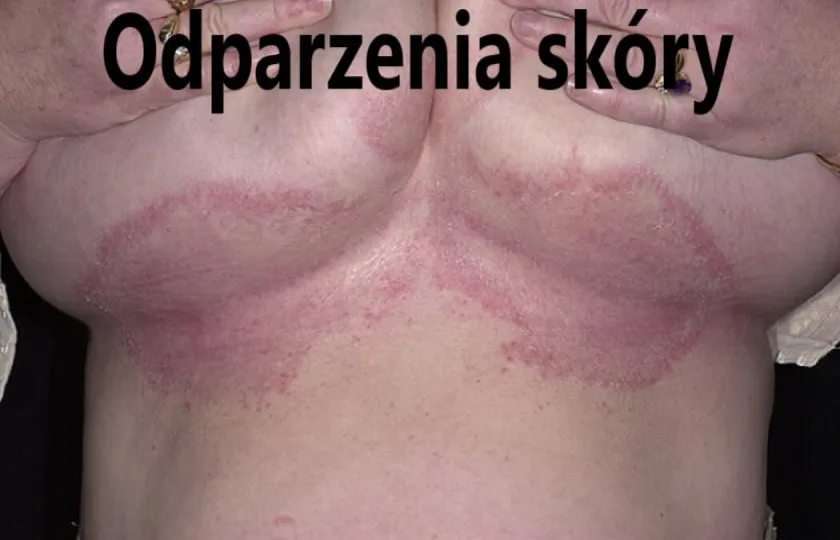 odparzenia skóry