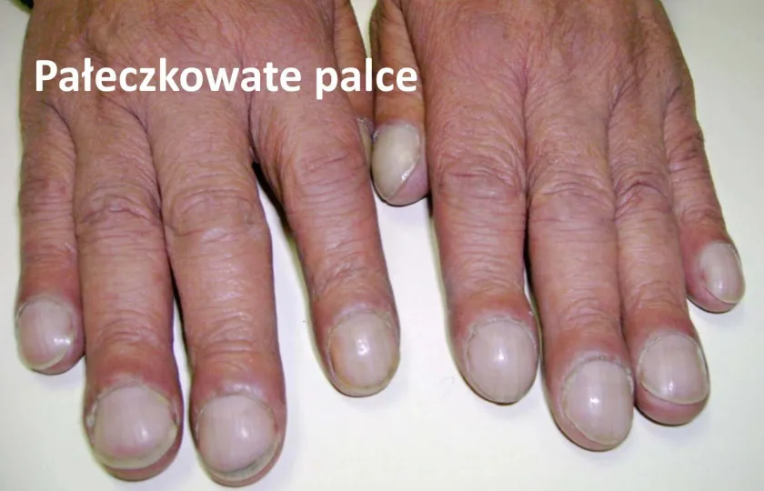 Pałeczkowate palce, pałeczkowatość palców