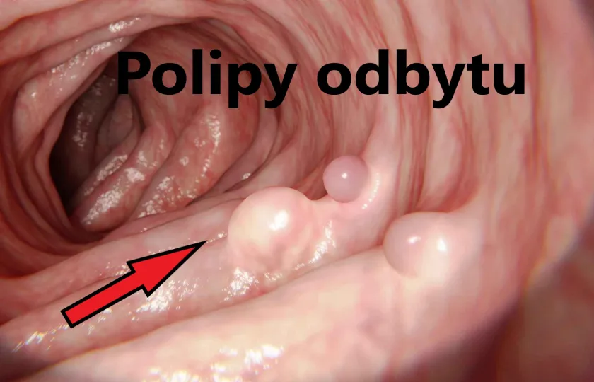 Polipy odbytu, polipy odbytnicy