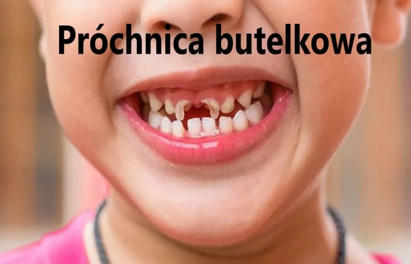 próchnica butelkowa