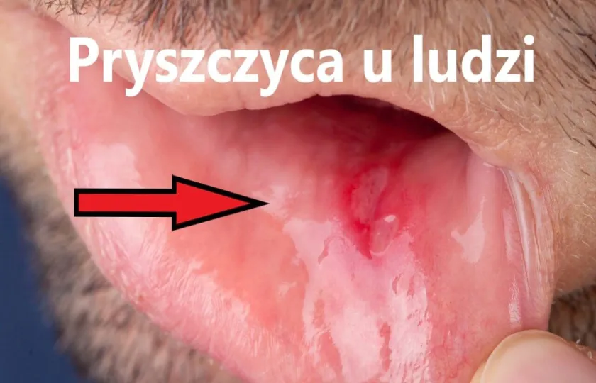 Pryszczyca u ludzi