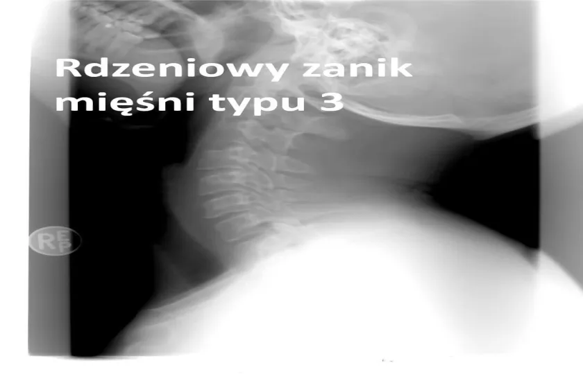 rdzeniowy zanik mięśni typu 3